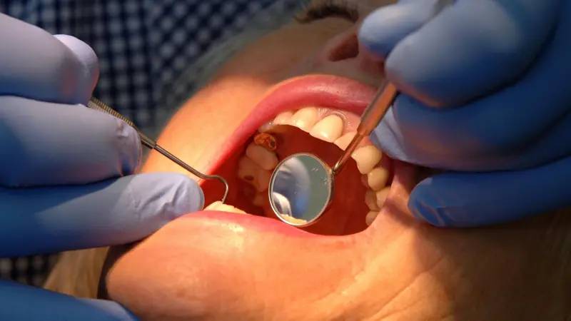 dis minesini onaran yeni jel curuklerin sonu mu geliyor sc5O4jEC.jpg